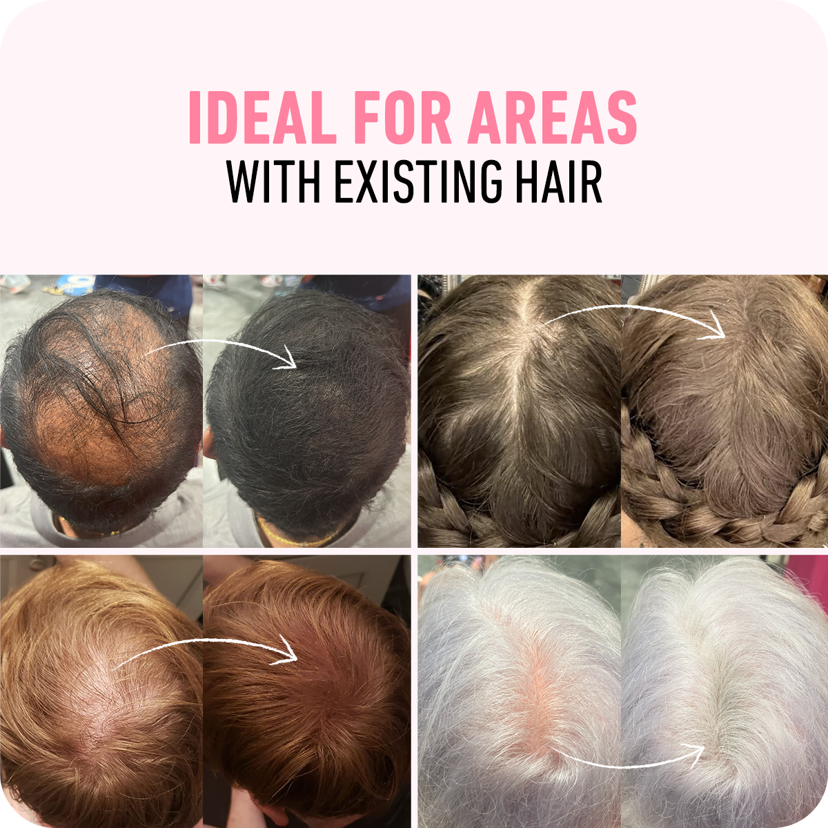 Ideal For areas with existing hair before and after